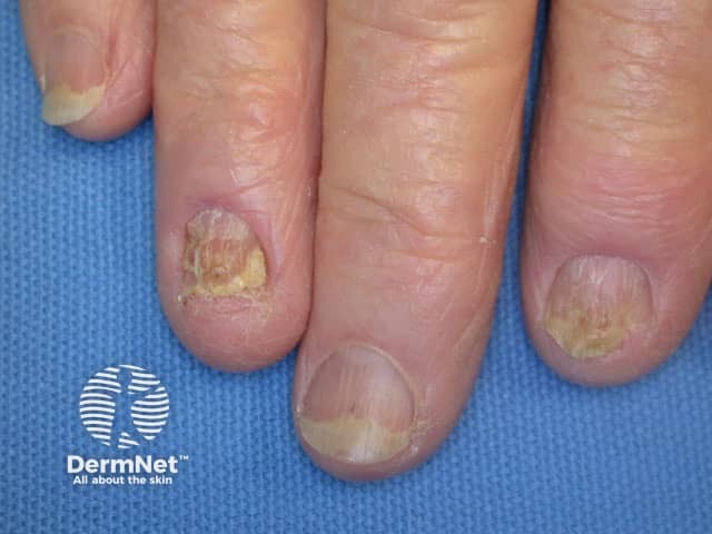 Nail lichen planus: onycholysis seen in 3rd and 5th fingernails