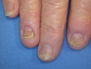 Nail dystrophy of lichen planus