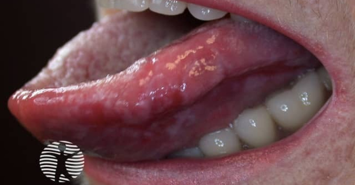 Erosive Oral Lichen Planus Image