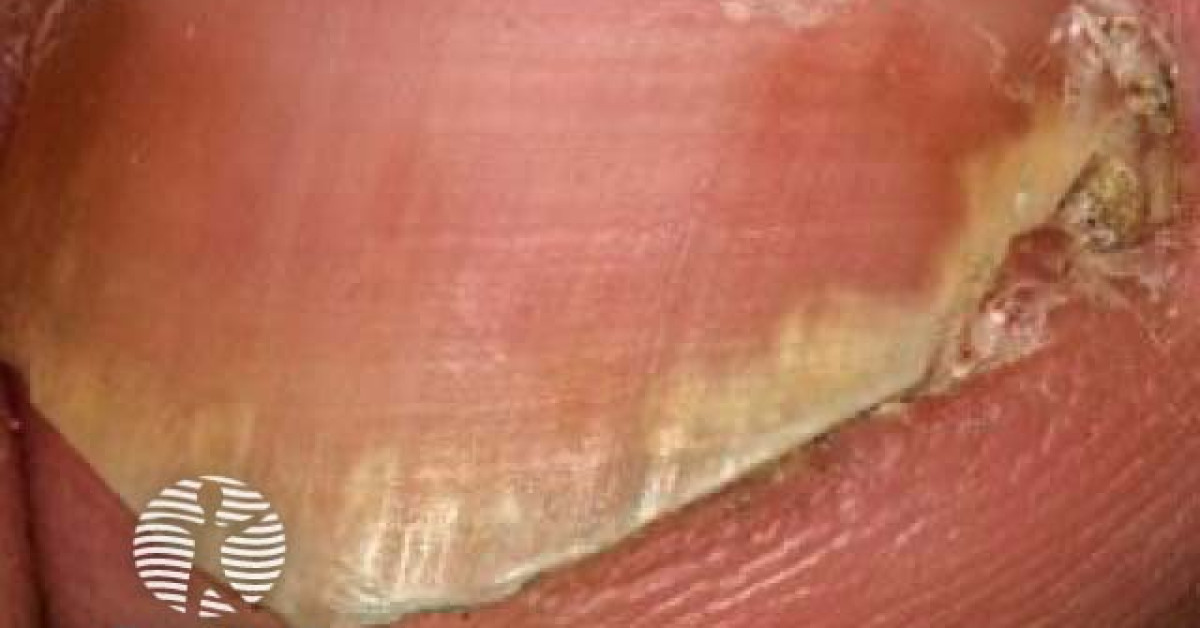 DermNet® - Nail psoriasis image