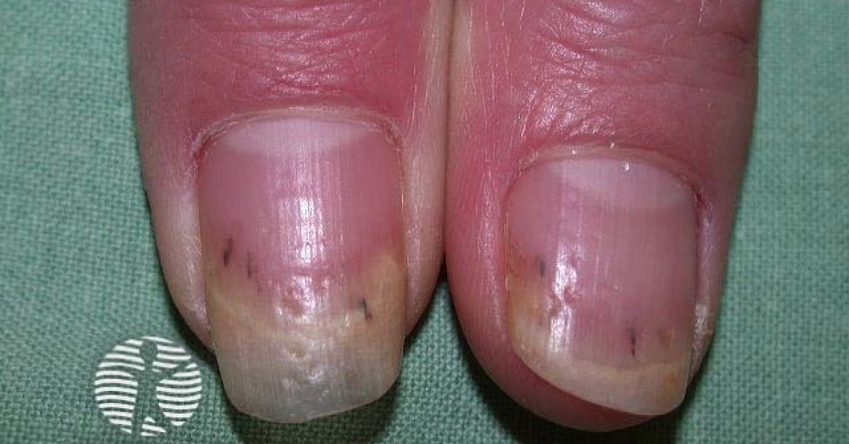 Fingernails Dos and donts for healthy nails Mayo Clinic