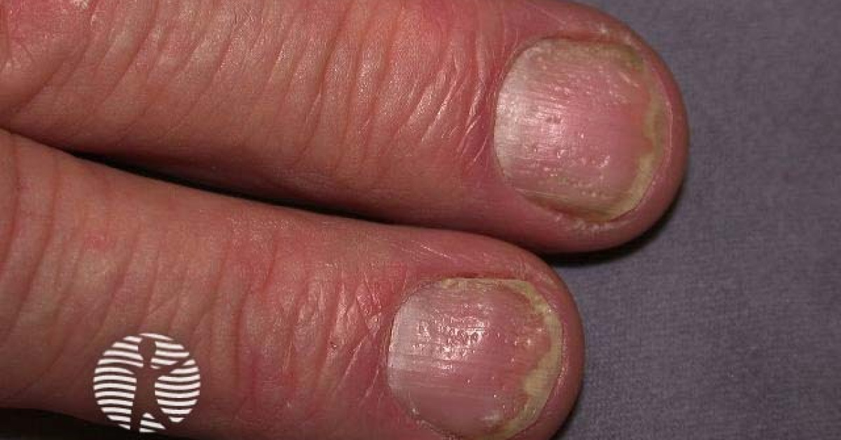 Adult health Nail care Mayo Clinic