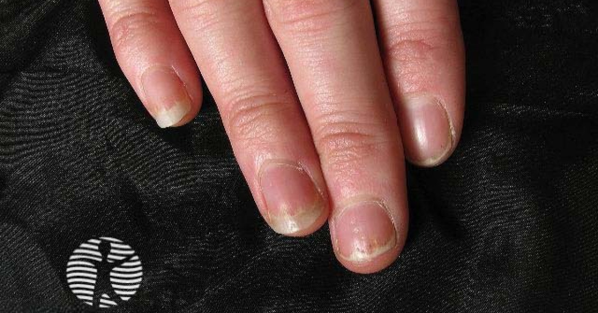 Nail psoriasis image