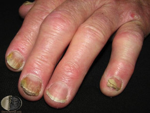 Psoriasis in the fingernails and toenails