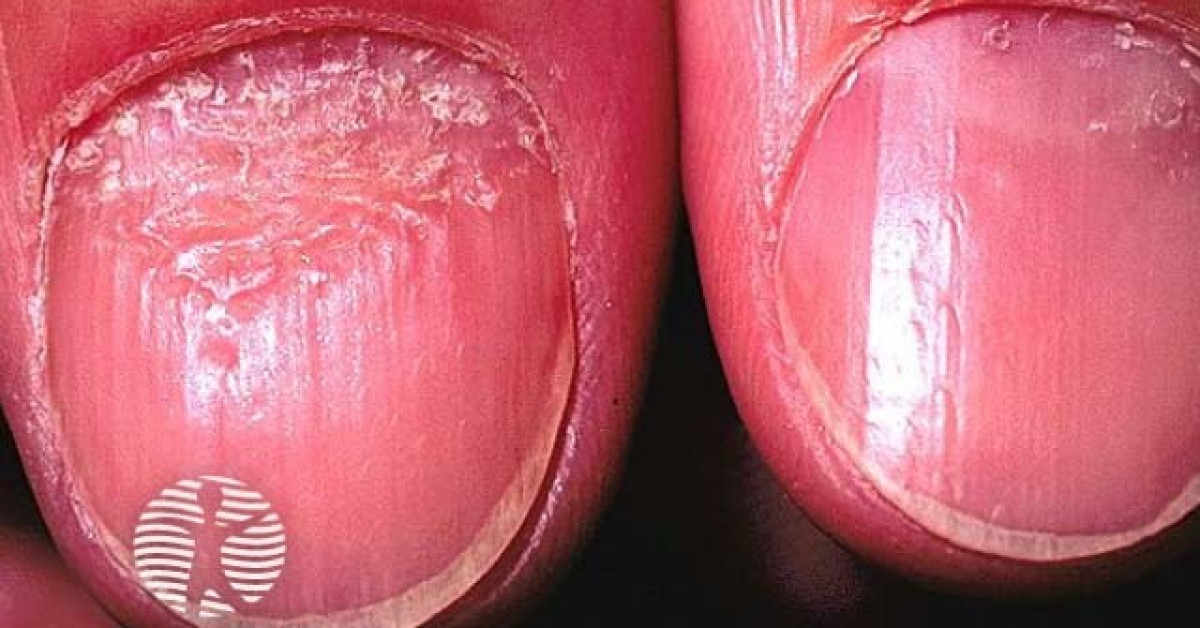 7 fingernail problems not to ignore Mayo Clinic