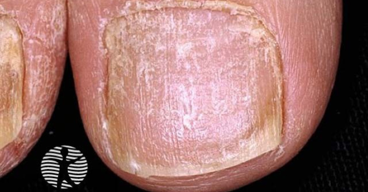 Nail fungus Symptoms and causes Mayo Clinic