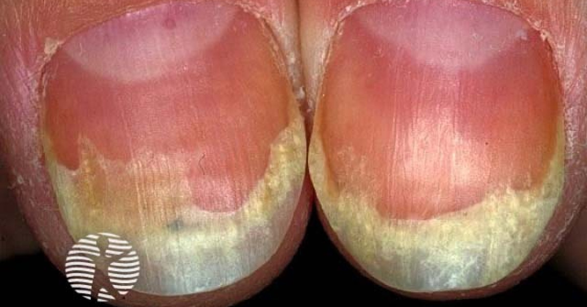 Nail fungus Diagnosis and treatment Mayo Clinic