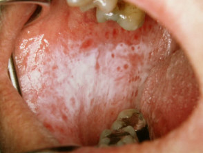 reticular oral lichen planus