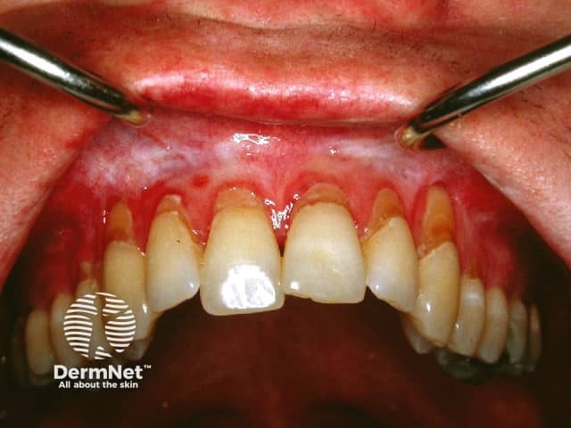 Oral graft versus host disease