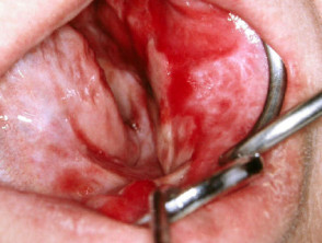 Ulcerative oral lichen planus