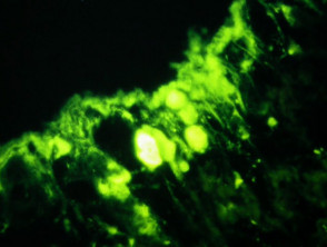 Immunofluorescence of lichen planus