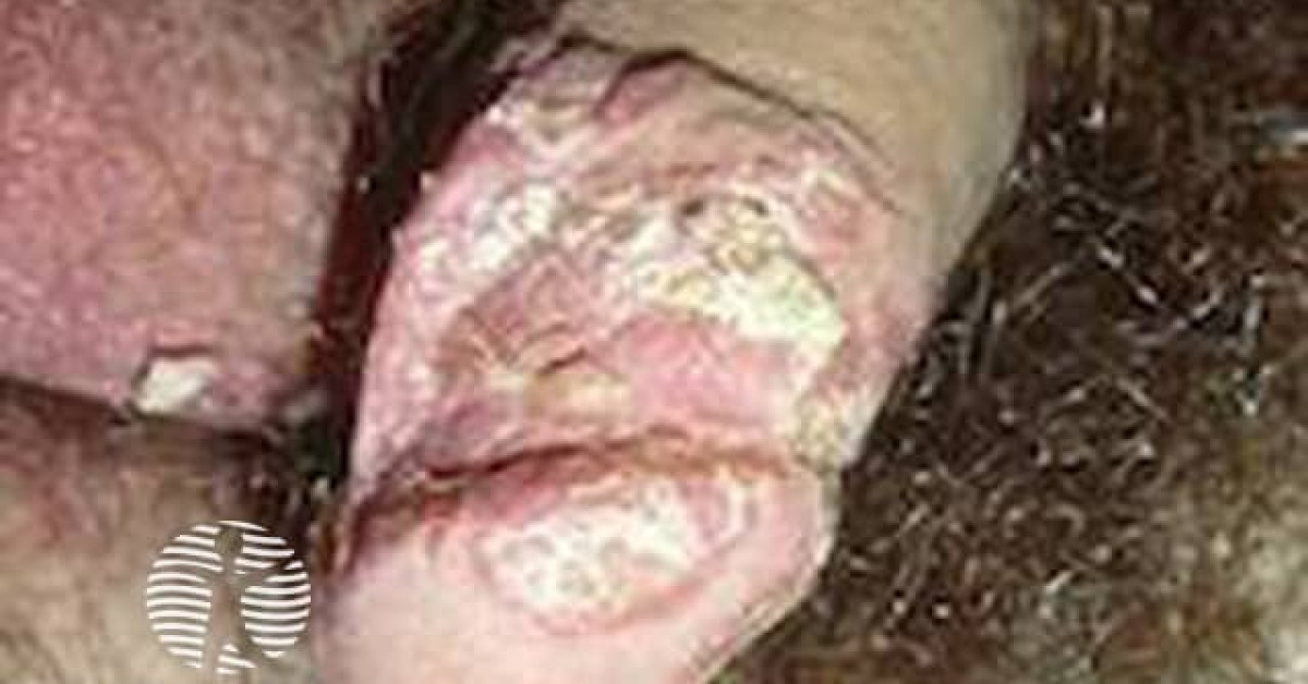Penile psoriasis image