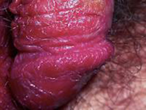 Penile psoriasis