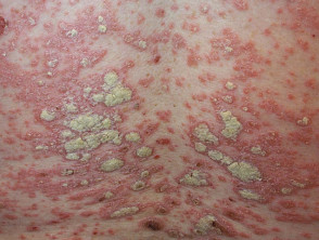 Inflammation and skin conditions