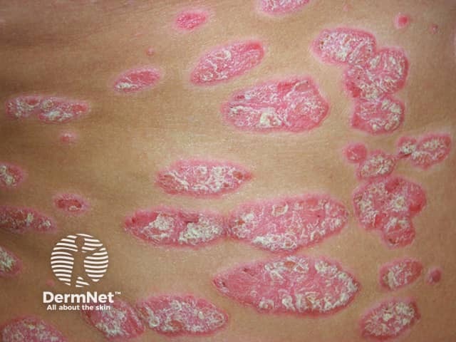Large plaque psoriasis lesions on the trunk - pink, well-defined with overlying thick scale