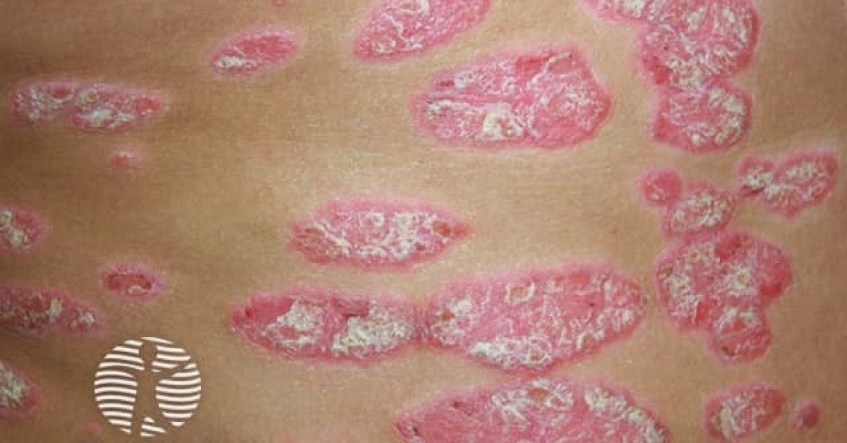 Chronic Plaque Psoriasis Image chronic-plaque-psoriasis-image