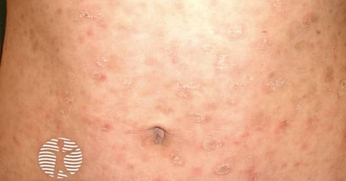 Pityriasis Lichenoides Chronica Image