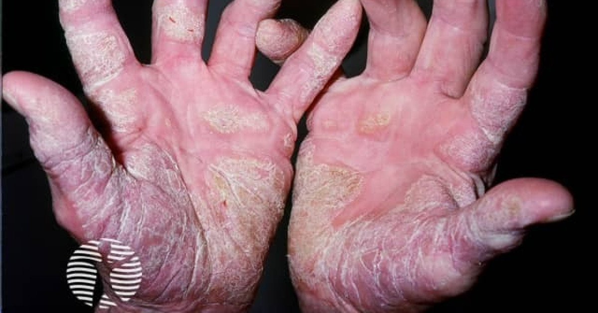 Palmoplantar psoriasis image