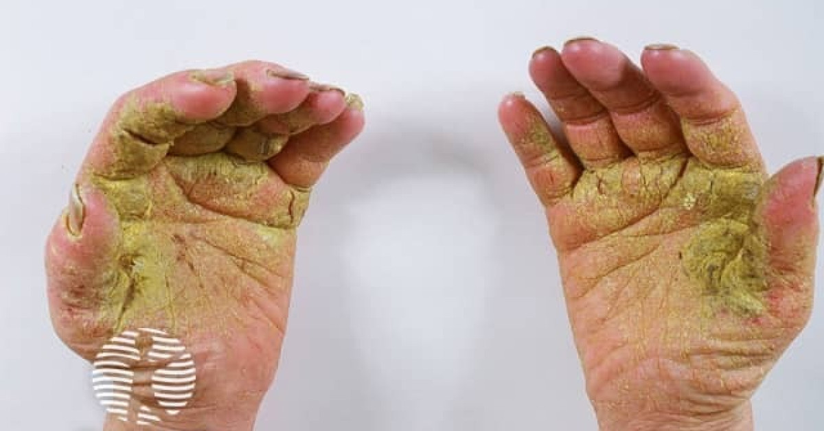 DermNet® - Palmoplantar psoriasis image