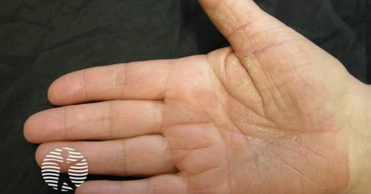 Palmoplantar psoriasis image