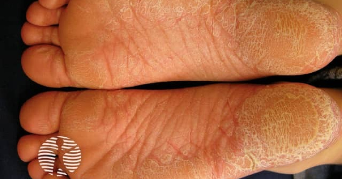 Palmoplantar psoriasis image