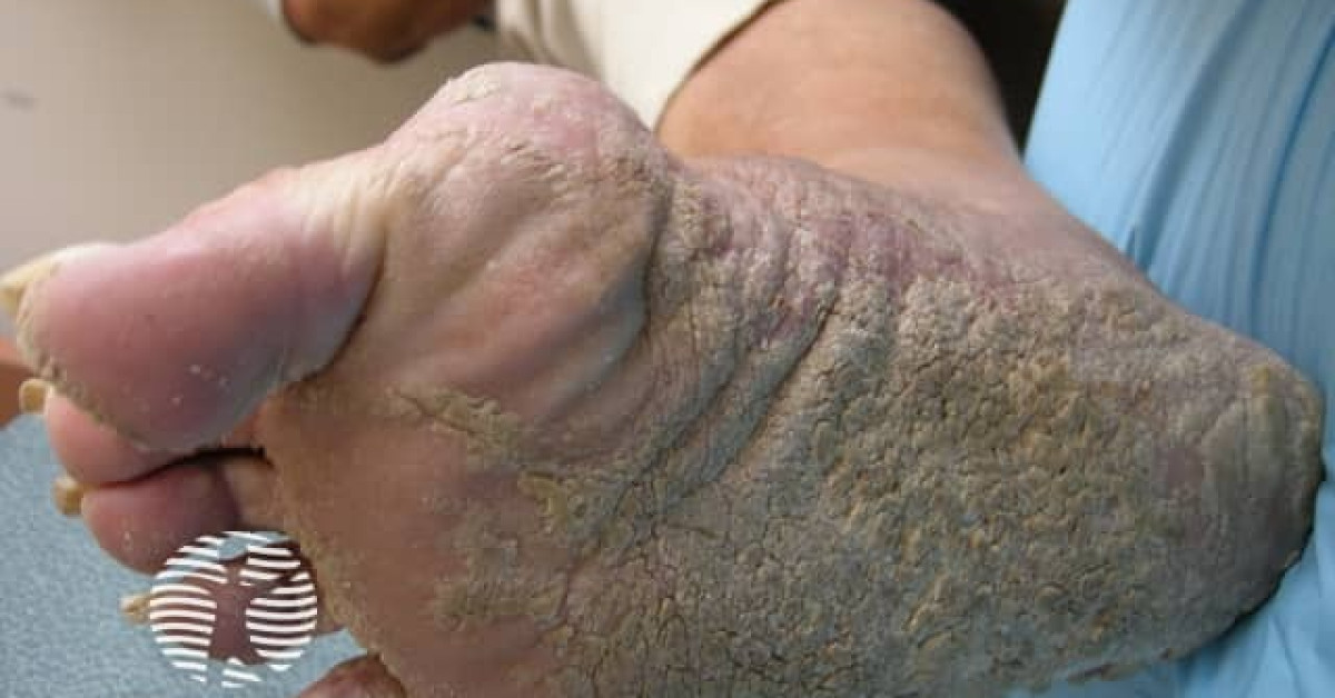 Palmoplantar psoriasis image