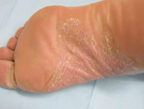 Palmoplantar psoriasis
