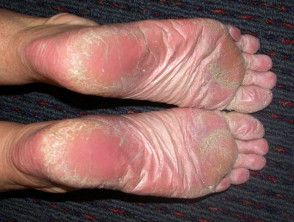foot palm cracks