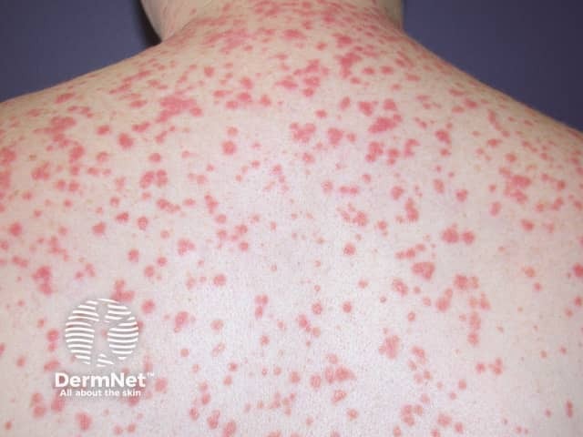 Small plaques of psoriasis appear almost like rain drops splashed over the skin