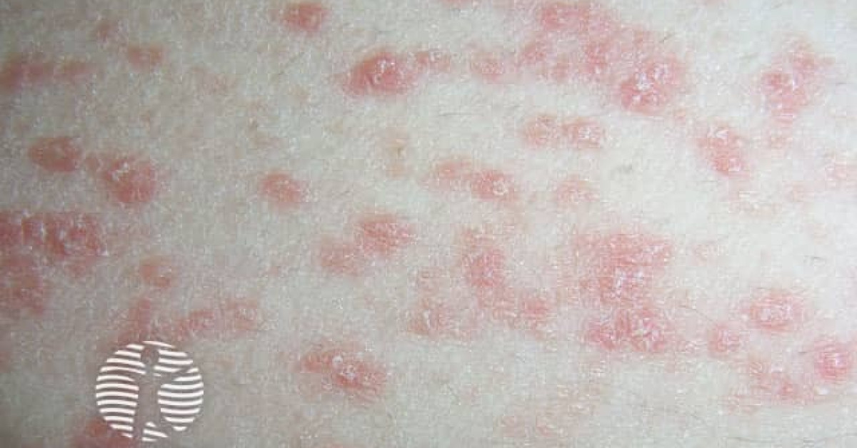 Guttate psoriasis image