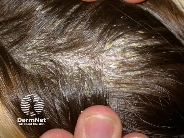 Well-defined scaly patches of psoriasis in the scalp