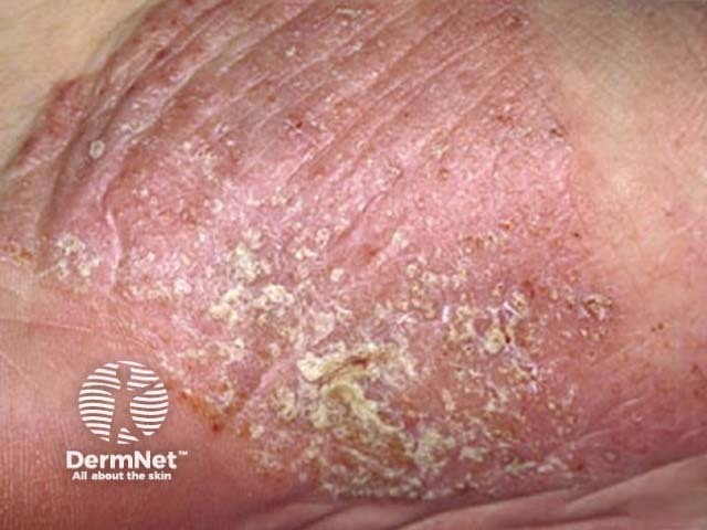 Pustular psoriasis of the hands and feet