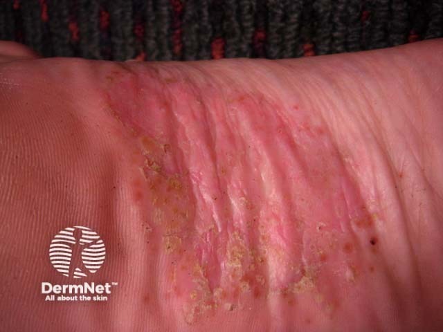 Pustular psoriasis of the hands and feet