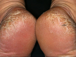 sore heel cracked skin