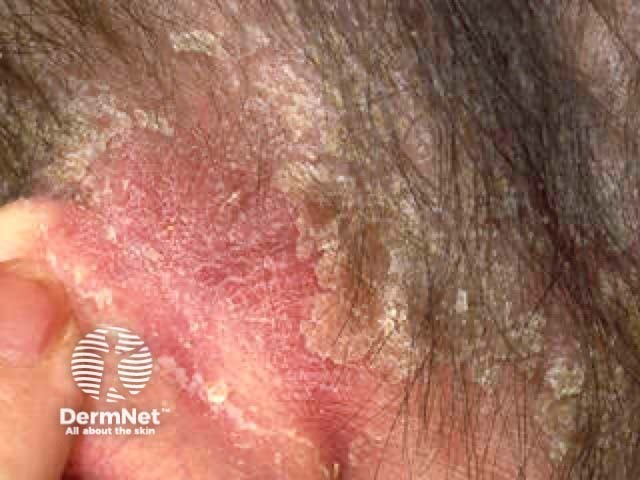 Sebopsoriasis affecting the retroauricular skin