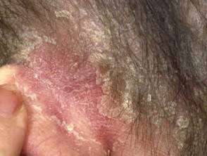 Sebopsoriasis of scalp