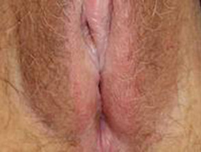 Vulval psoriasis