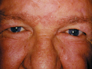 Facial Psoriasis Dermnet Nz