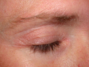 Eyelid psoriasis