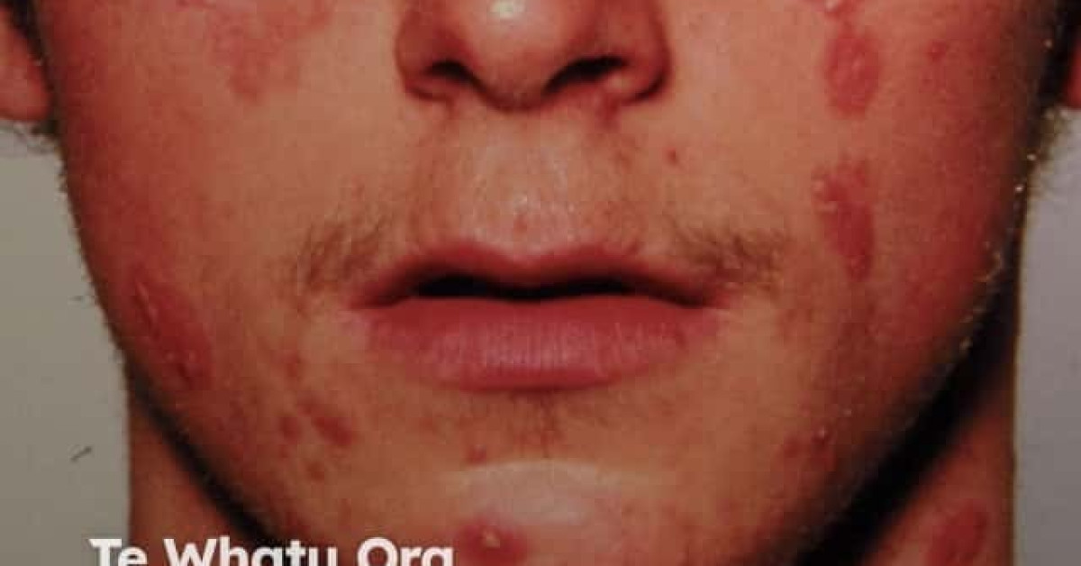 Vibrant Can You Get Psoriasis On Your Face Photo Nature Vibrant Can You Get Psoriasis On Your Face Photo Nature