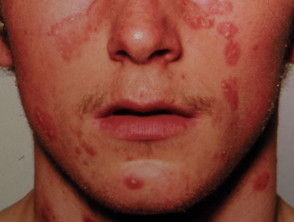 Facial psoriasis