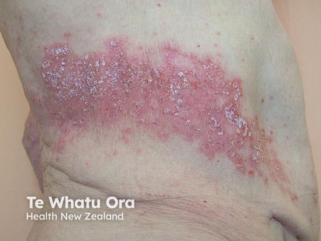 Shingles (herpes zoster)