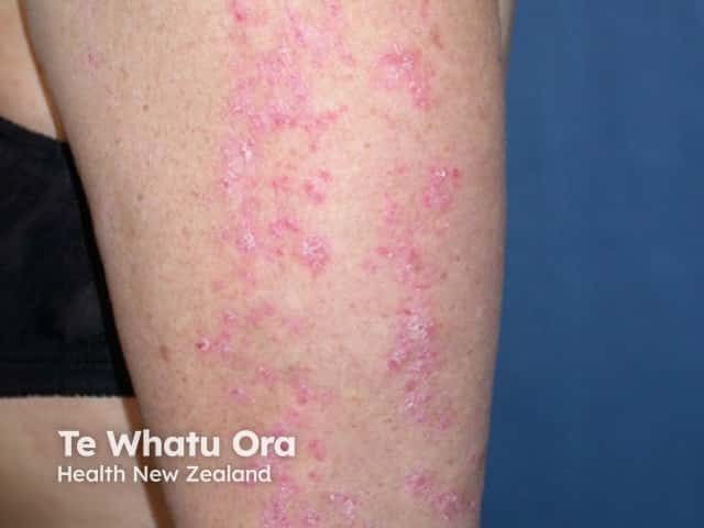 Linear psoriasis following the lines of Blaschko