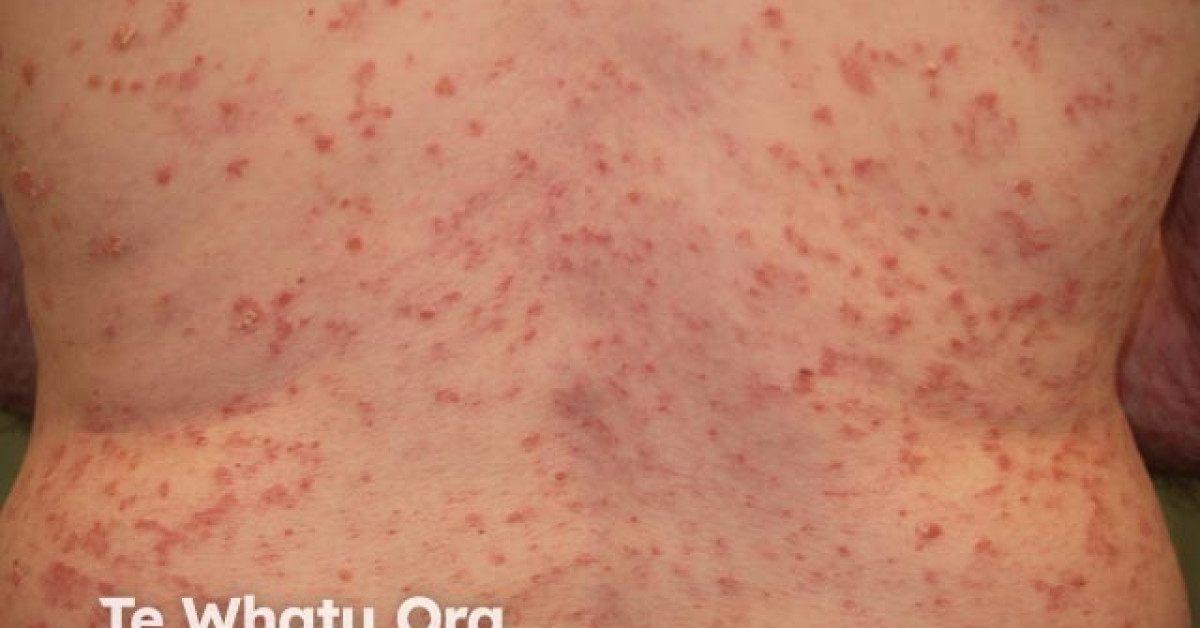 DermNet® - Small Plaque Psoriasis Image