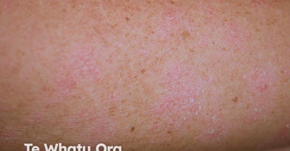 DermNet® - Small Plaque Psoriasis Image