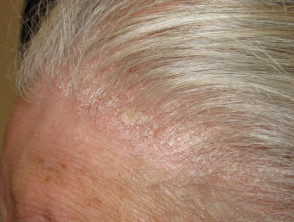 Psoriasis scalp