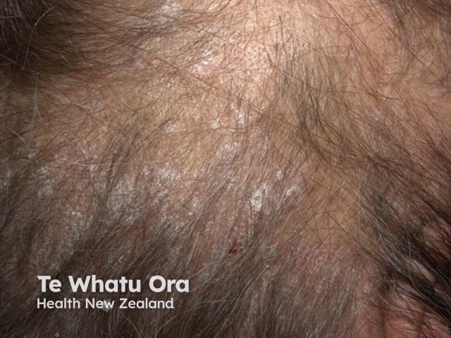 Adherent scale in scalp psoriasis