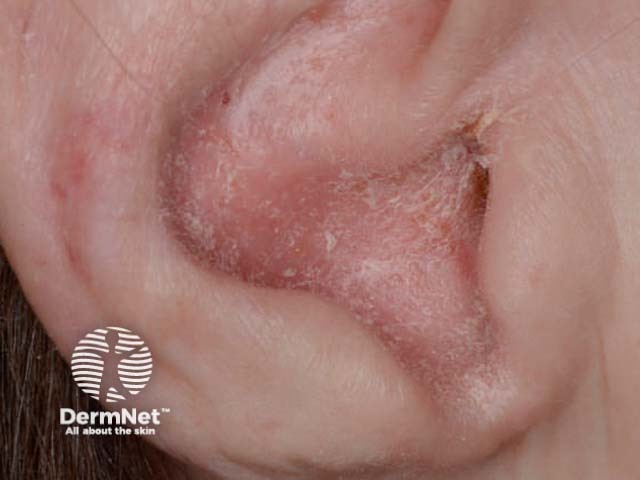 Sebopsoriasis of ear
