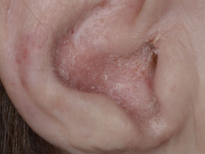 Sebopsoriasis of ear