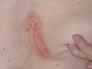 Sebopsoriasis of chest